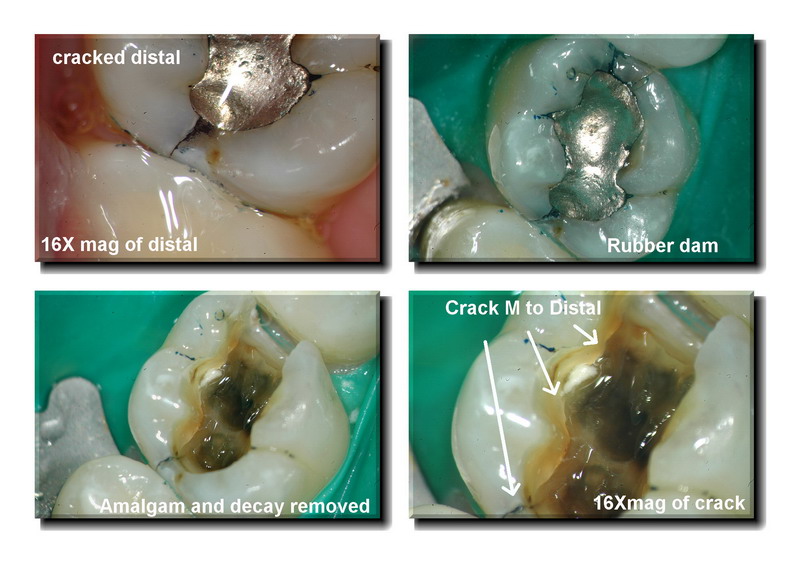 Cracked tooth pg 2 edited_resize.jpg